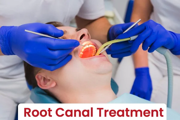 Root Canal Treatment