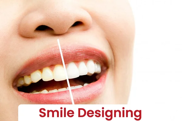 Smile Designing