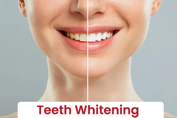 Teeth Whitening