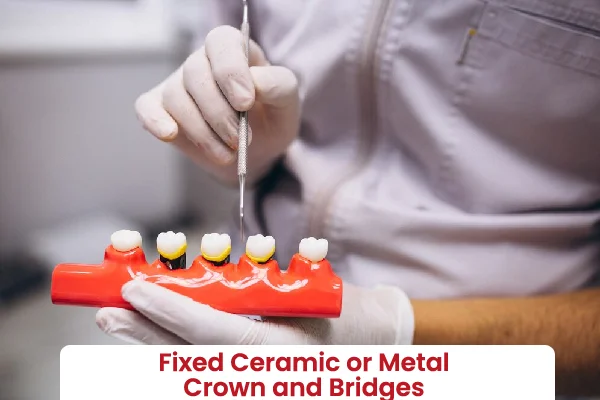 Fixed (Ceramic, Metal and Bridges)