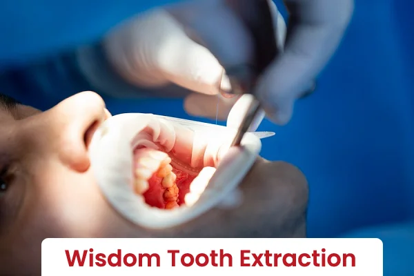 Wisdom Tooth Extraction